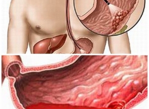  Bệnh chảy máu dạ dày có nguy hiểm không 